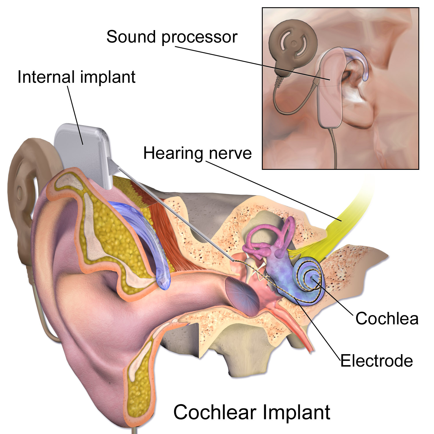 Altersabhängige Kosteneffektivität von Cochlea-Implantationen bei Erwachsenen